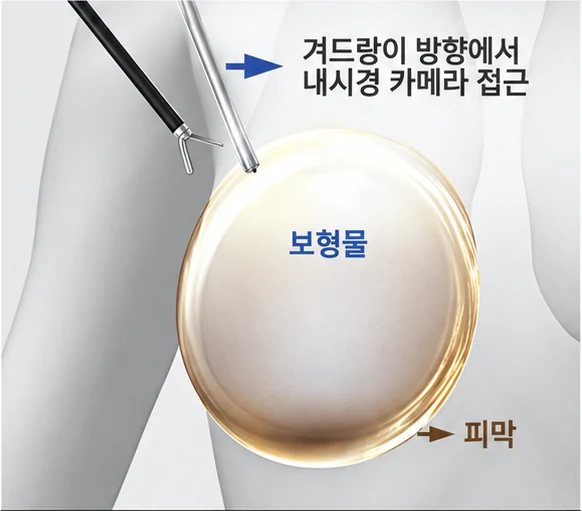 피막 제거 1단계
