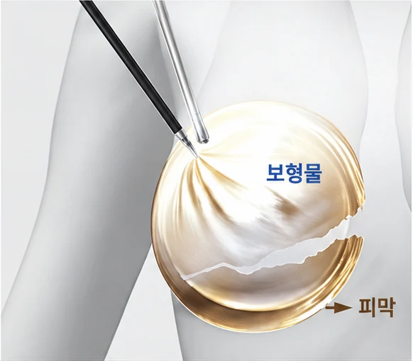 피막 제거 2단계