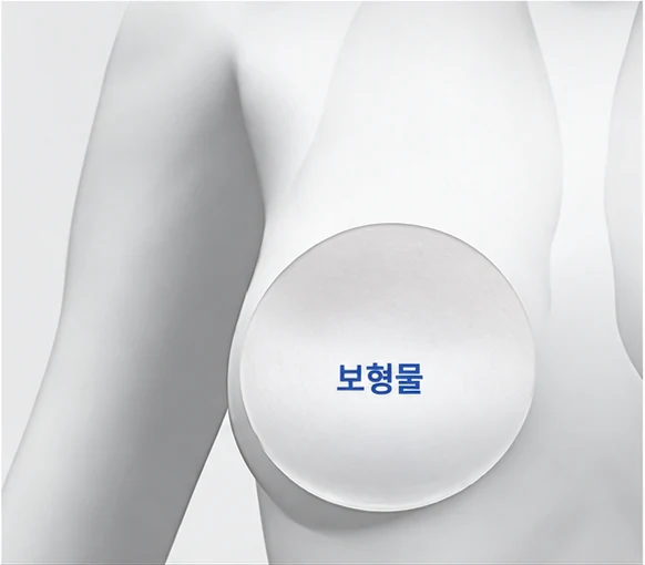 새 보형물 삽입